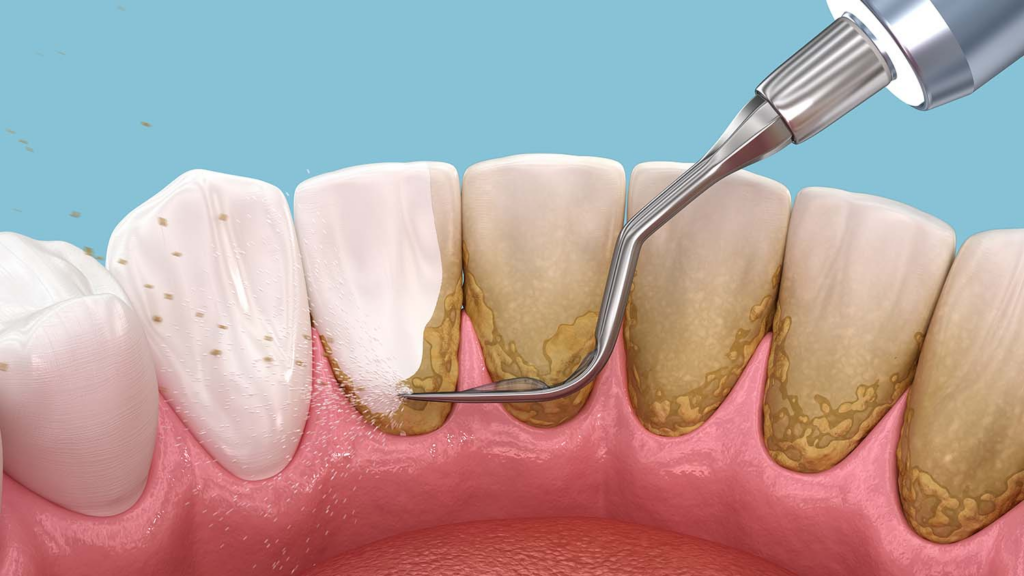placa bacteriana